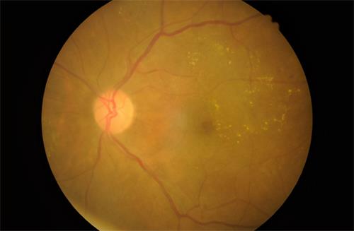 视网膜色素变性示意图 视网膜色素变性示意图