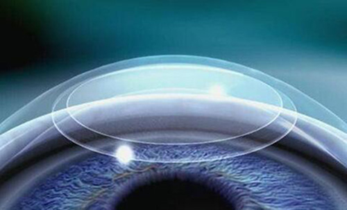 近视矫正手术的20个常见问题详解，不得不看！