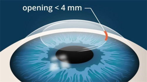 近视激光手术价钱多少钱？影响价格的因素有哪些？