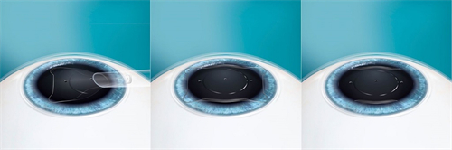 ICL晶体植入过程 ICL晶体植入过程