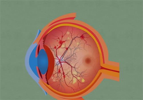 视网膜色素变性的眼睛