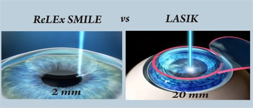全飞秒近视手术带来的切口图解 全飞秒近视手术带来的切口图解