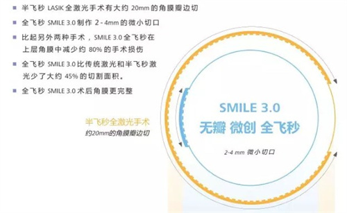 全飞秒手术3 全飞秒手术3