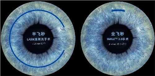 半飞秒与全飞秒区别解析：如何选择近视手术更合适？