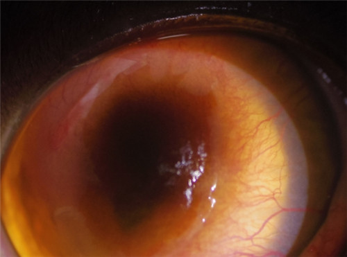 角膜疾病照片 角膜疾病照片