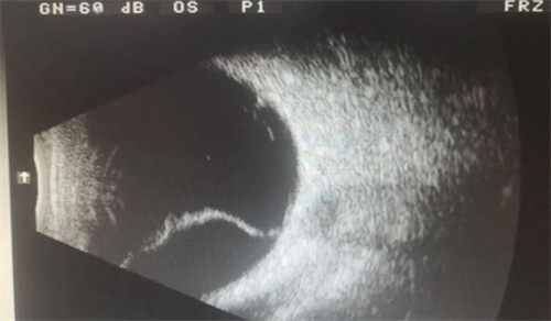 视网膜脱落的眼底 视网膜脱落的眼底