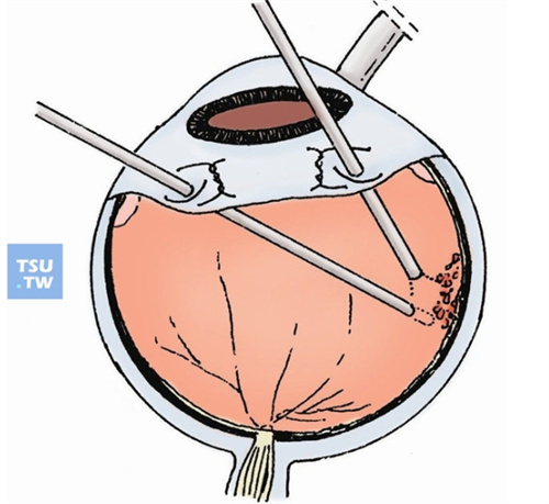 视网膜脱离后多长时间内做网脱手术合适？网脱手术多少钱？白内障引起的网脱手术还需要再次付费吗？