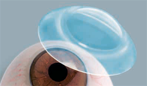 巩膜镜展示图 巩膜镜展示图