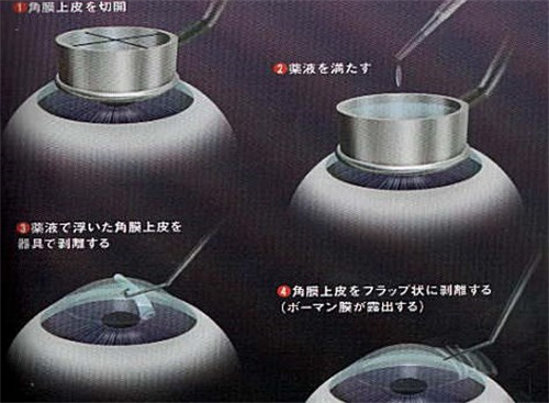 2025年合肥芜湖蚌埠阜阳近视矫正/散光/远视/屈光不正/眼表疾病价格表