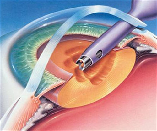2025年3月洛阳新乡郑州许昌南阳平顶山近视矫正/散光/远视/屈光不正/眼表疾病价格表 