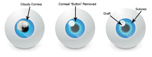 角膜移植图示 角膜移植图示