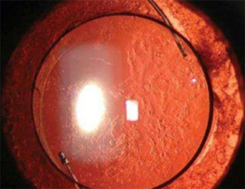 后发障眼球照片 后发障眼球照片