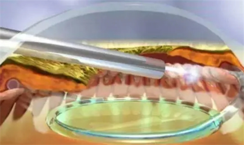 青光眼的症状和表现是什么？有恢复方法吗？