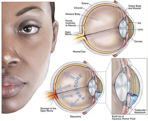 青光眼滤过泡修补术是什么？多少钱可以做？贵不贵？
