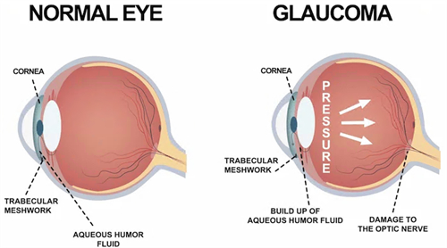 青光眼和正常眼睛对比 青光眼和正常眼睛对比
