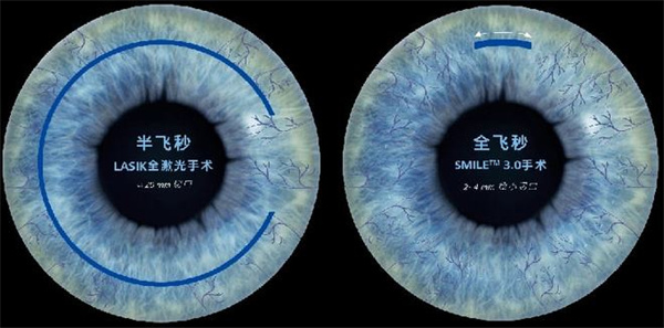 2025年3月潮州台山阳春顺德近视矫正/散光/远视/屈光不正/眼表疾病价格表 