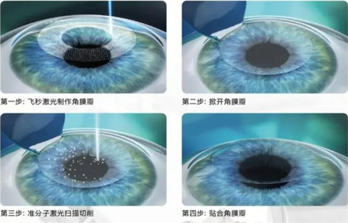 2025年3月梧州北海贵港钦州近视矫正/散光/远视/屈光不正/眼表疾病价格表 