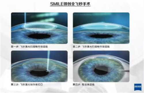 全飞秒手术过程图解 全飞秒手术过程图解