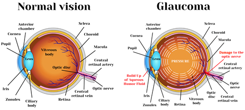 正常眼睛和青光眼的对比图 正常眼睛和青光眼的对比图