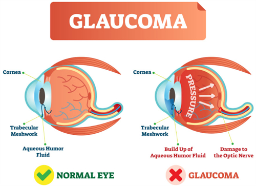 正常眼睛和青光眼的对比 正常眼睛和青光眼的对比