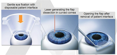 近视不戴眼镜会加重近视吗？一文深刻理解眼镜在近视矫正中的作用！