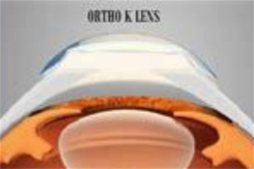 角膜塑形镜2 角膜塑形镜2