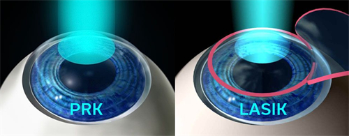 高度近视会遗传下一代吗？