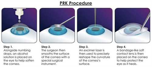 近视矫正方法有哪些？除了近视眼镜，近视矫正手术的利与弊有哪些？
