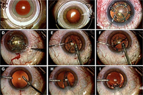 全飞秒和半飞秒手术有什么区别？都多久恢复视力？