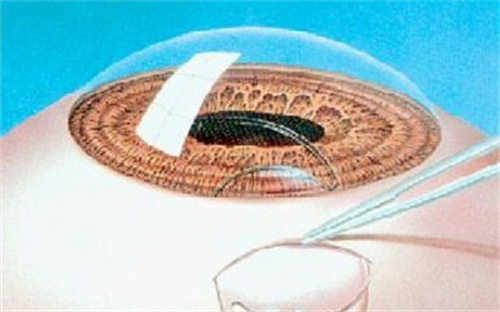 2025年北京市全飞秒手术价格趋势分析