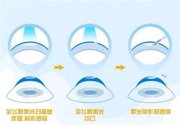 全飞秒激光眼睛照片 全飞秒激光眼睛照片