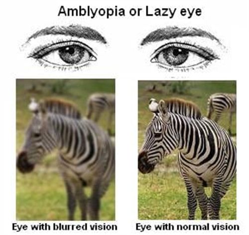 正常眼睛和弱视视野不一样 正常眼睛和弱视视野不一样