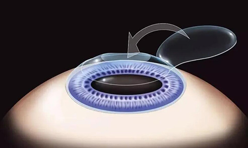 近视矫正手术是否适合所有人"等20个近视矫正的问题，快来看吧！