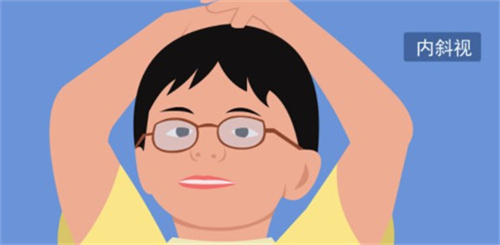 小儿斜视：20个问题全方面解析，当父母的你不可不知道！