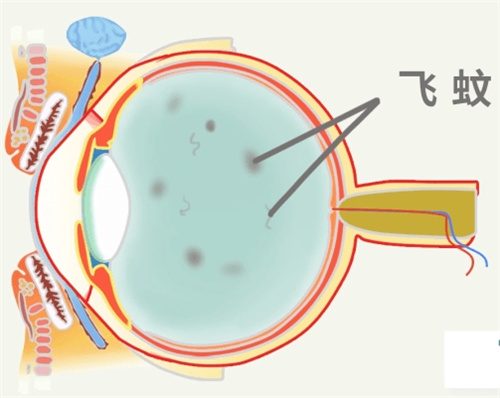飞蚊症图片 飞蚊症图片