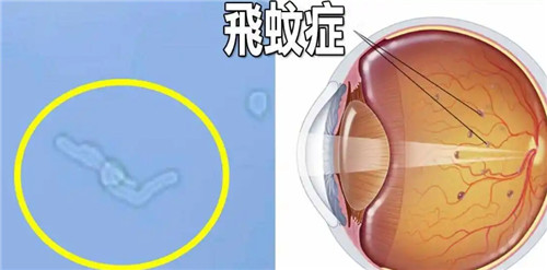 飞蚊症症状图片 飞蚊症症状图片