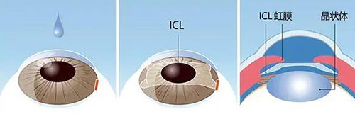 晶体植入改善展示图 晶体植入改善展示图