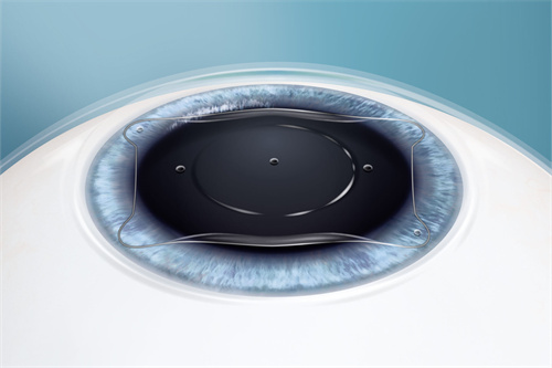 晶体植入好还是飞秒好？两者优缺点对比解析