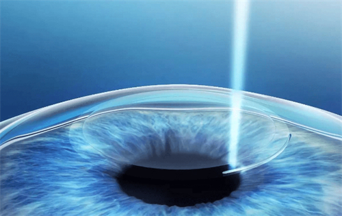 绿飞秒手术过程图解 绿飞秒手术过程图解