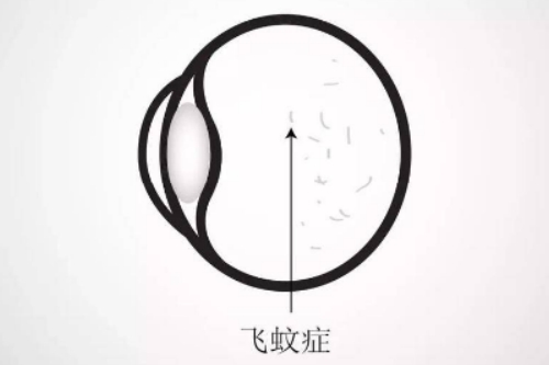 飞蚊症卡通图片展示 飞蚊症卡通图片展示