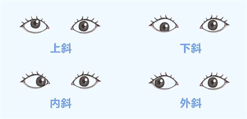 上斜下斜内斜外斜的区别 上斜下斜内斜外斜的区别