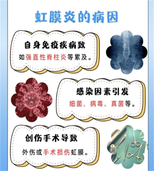 为啥我会得虹膜炎？早期治疗为何如此重要！