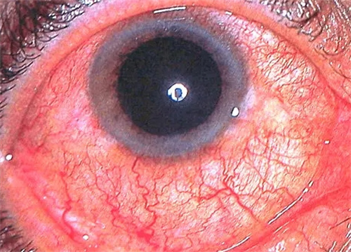 虹膜炎眼部照片 虹膜炎眼部照片