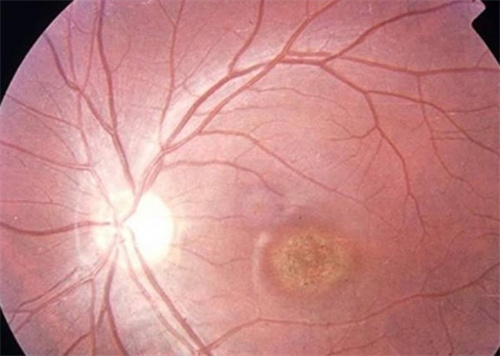 虹膜炎图片 虹膜炎图片