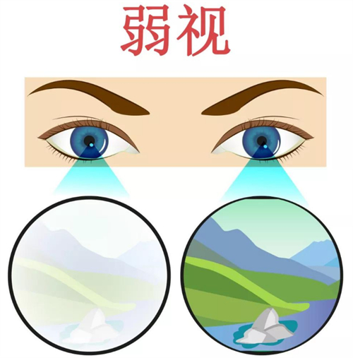 弱视和正常眼镜区别 弱视和正常眼镜区别
