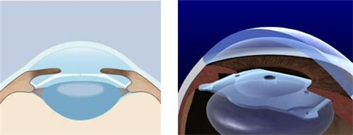 ICLV5晶体植入位置 ICLV5晶体植入位置