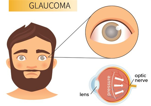为什么会得青光眼，青光眼为什么会头疼？附青光眼相关问题！