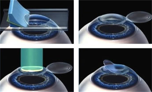 激光矫正近视贵吗？不同手术方式的价格差异