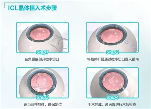 ICL晶体植入第几代了？最新V5晶体技术+个性化矫正方案