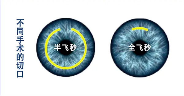 半飞秒和全飞秒区别 半飞秒和全飞秒区别